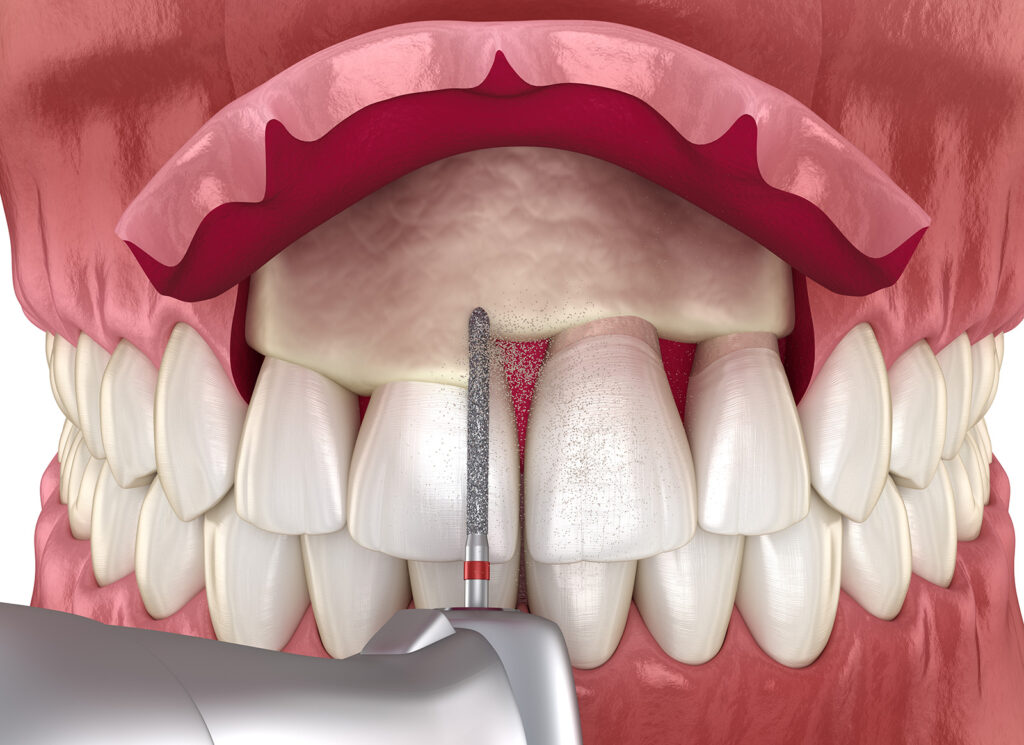 crown lengthening image