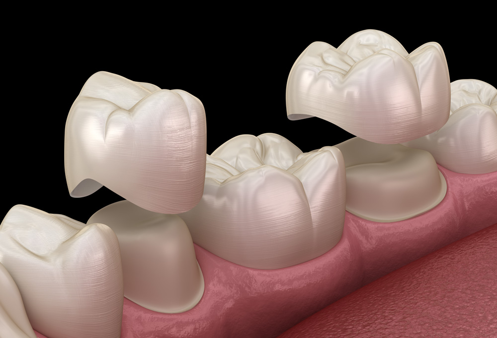 stock photo porcelain crowns placement over premolar and molar teeth medically accurate d illustration