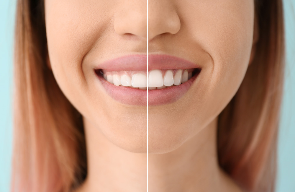 stock photo young woman before and after procedure of gingival plasty closeup