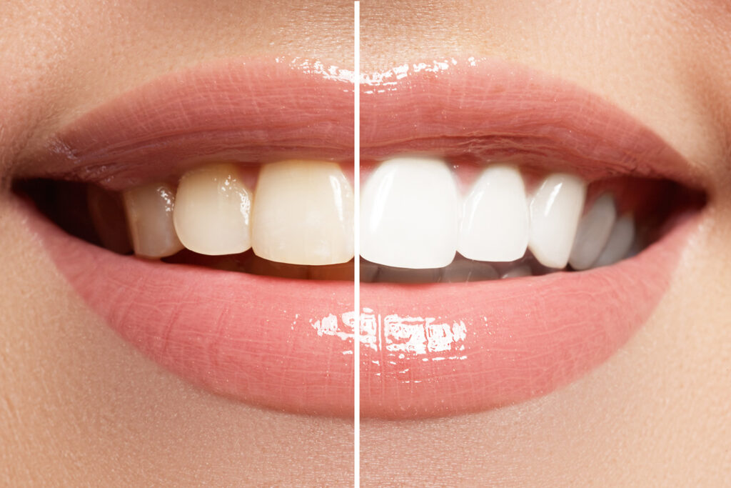 teeth whitening image 1