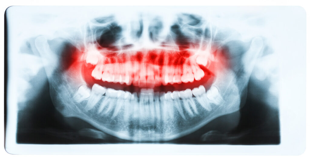 xray wisdom teeth